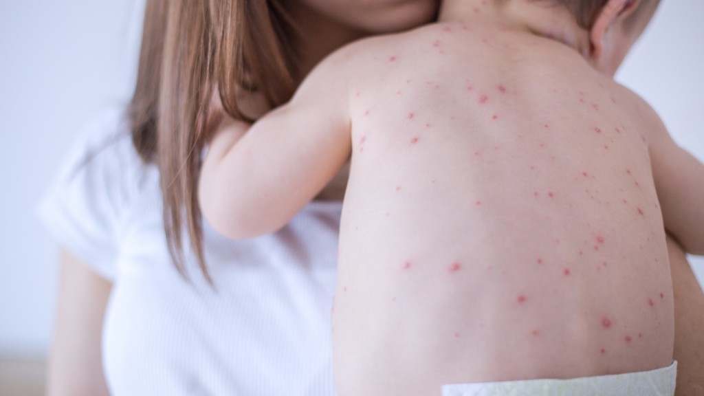 Comment prendre soin de la peau de bébé pendant la varicelle ?