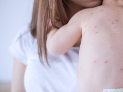 Comment prendre soin de la peau de bébé pendant la varicelle ?